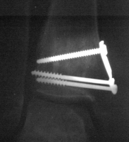 Right Ankle X-ray